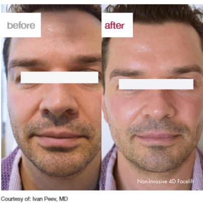 4d facelift