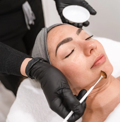 Chemical peels service