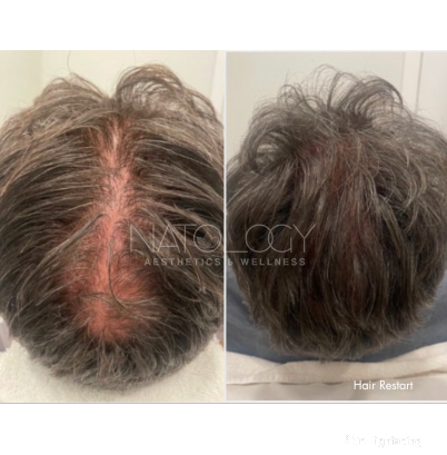 Hair treatment