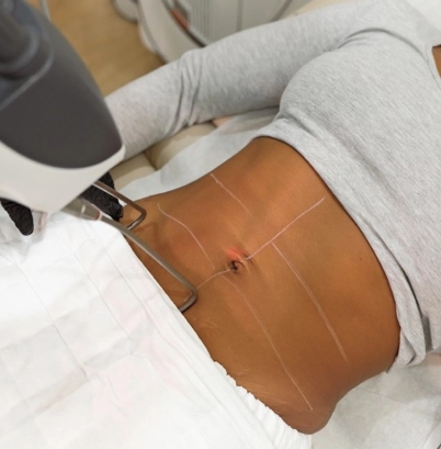 Tightsculpting service