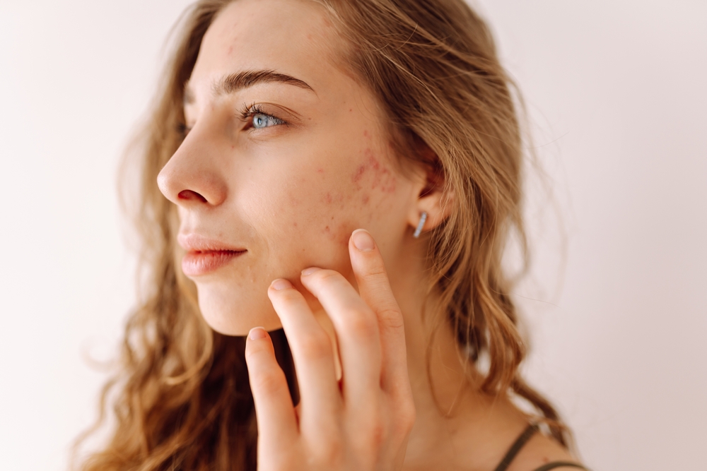 Hormonal acne treatments