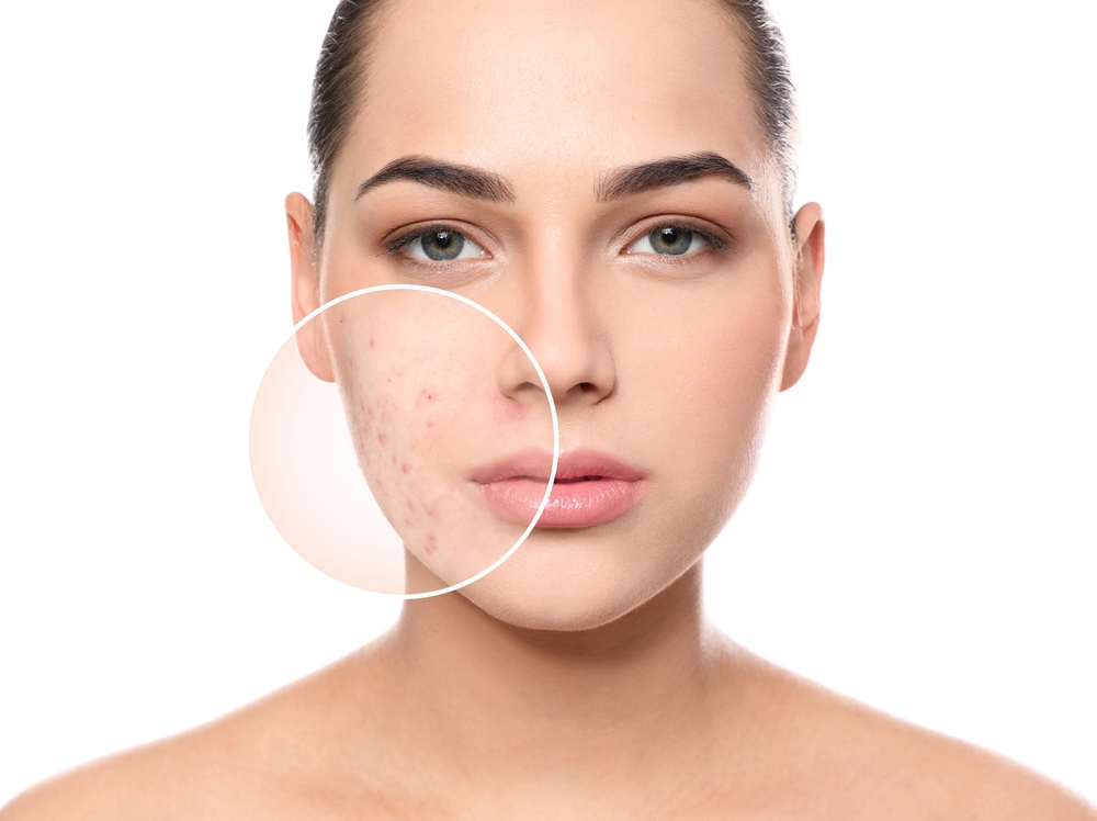 Chemical peels for acne scars